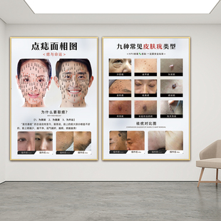 祛痣点痣广告海报美容院痣相图面部图男女面痣图面相祛疣取痣挂画