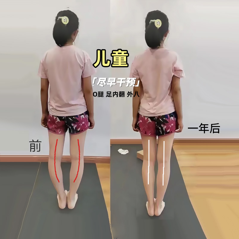儿童足内翻小孩专用外八字脚鞋垫