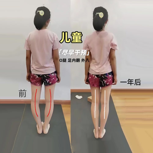 儿童鞋垫足内翻鞋底外侧磨损矫正