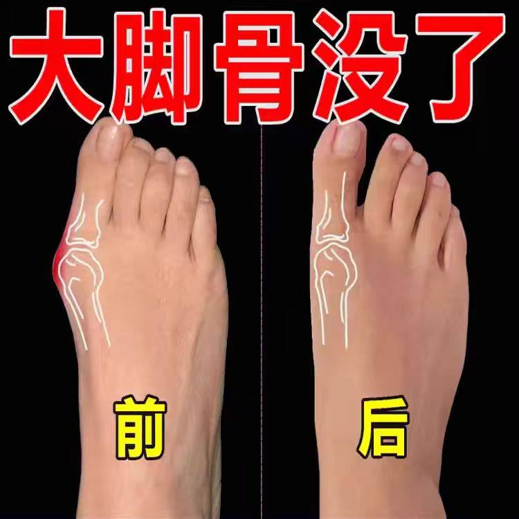 拇外翻穿高跟鞋神器脚趾重叠分离器脚歪大脚骨防磨拇指外翻矫正器
