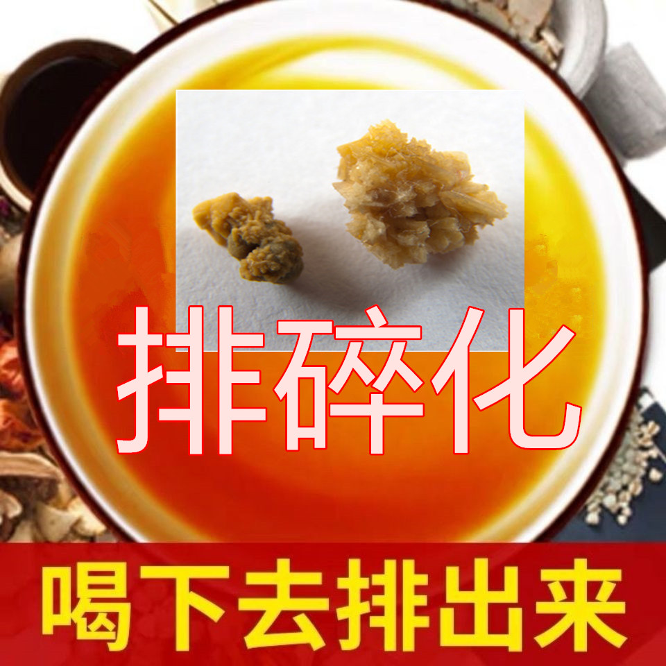 排石化石清石碎石鸡内金胆囊尿管