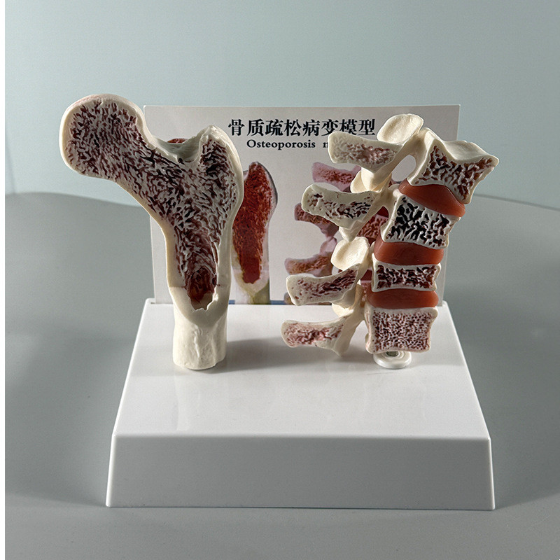 康泰医学教具骨质疏松模型骨密度变化骨折病变人体骨骼脊柱椎间盘