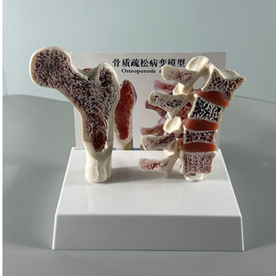 康泰医学教具骨质疏松模型骨密度变化骨折病变人体骨骼脊柱椎间盘