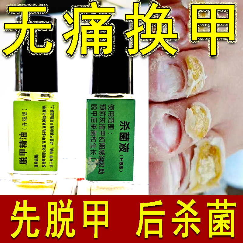 灰趾甲脱甲精油软甲膏抑菌生甲液
