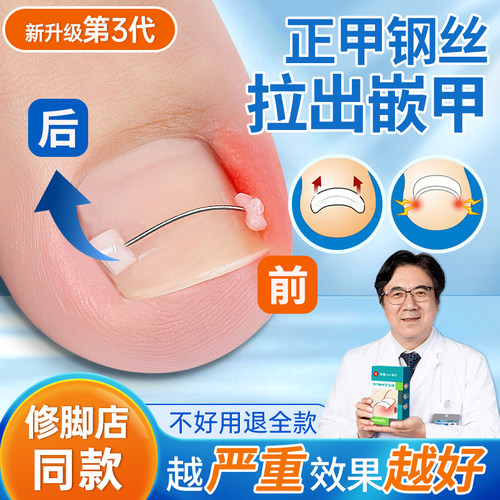 甲沟三代升级正甲记忆钢丝正甲贴