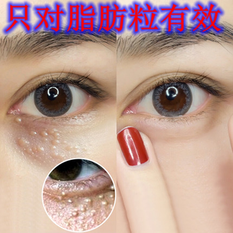 去脂肪粒汗管粒油脂粒眼部去除神器男女专用淡化清粒净精华素眼霜
