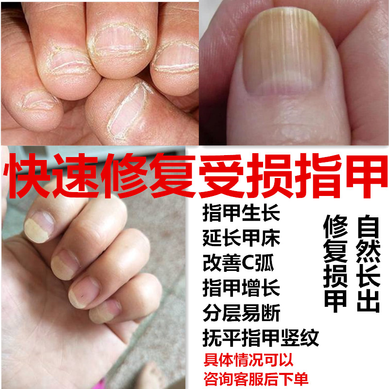 受损指甲增厚修复空分离护凹凸生长液竖纹薄软再生营养油手指脚趾