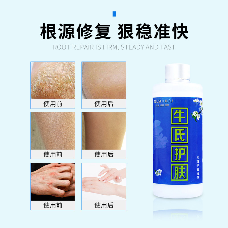 鱼鳞皮肤秋冬脚后跟干裂脱皮裂止痒润肤皮肤干燥干痒防裂冻皮肤霜