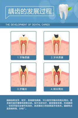牙齿龋齿的发展过程示意图解展