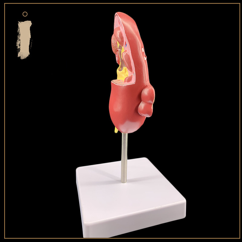인간 신장 해부학 모델 병든 신장 모델 인간 장기 해부학 모델 병든 내부 장기 병원 교육