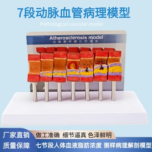 人体心脑血管动脉粥样硬化堵塞模型血栓血液脂肪病理解剖医学教具