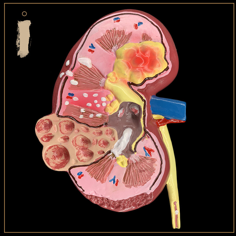 인간 신장 해부학 모델 병든 신장 모델 인간 장기 해부학 모델 병든 내부 장기 병원 교육