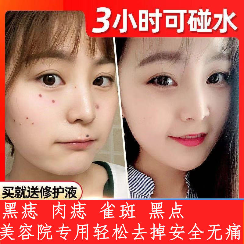 点雀斑药水点黑肉痣药水祛雀斑痣修复液美容金水1号去黑痣美容仪