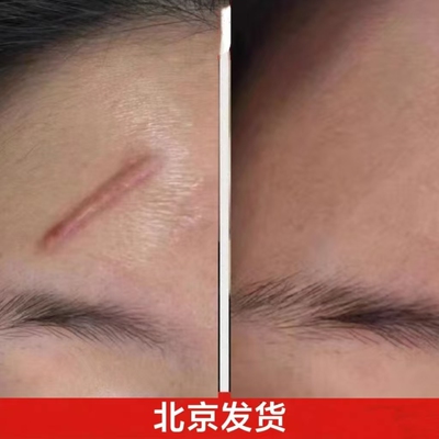 黑布去增生凸起疤痕疙瘩软化北京