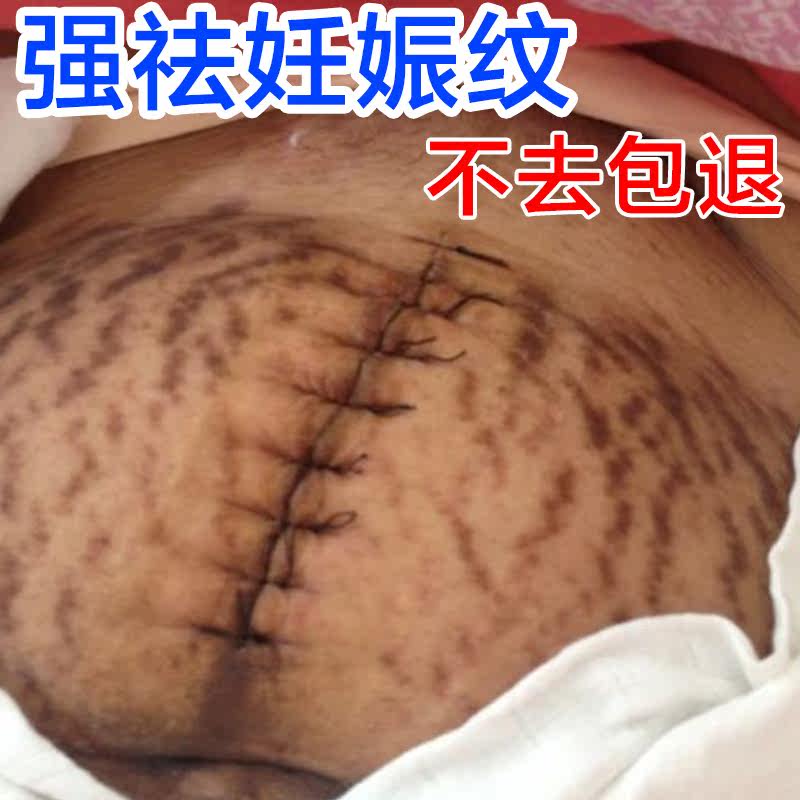 [2018专业美美店妊娠纹护理]【2019妊娠纹救星】孕妇专用强效去月销量44件仅售59.9元