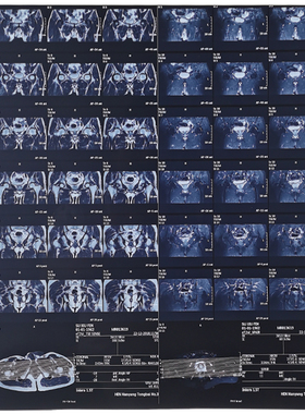 x光胶片教学用人体模型胶片CT片子腿部骨折片子胸片全身真实拍摄