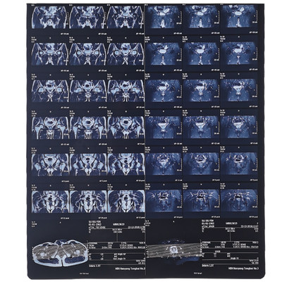 教学胶片影视道具胸片模型胶片