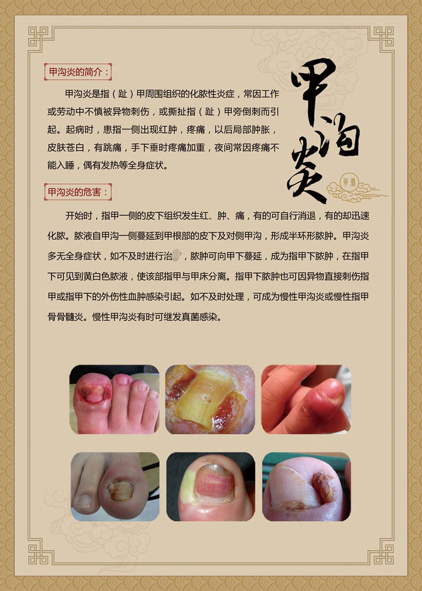 770医院宣传文化足疗修脚甲沟炎灰指甲的简介危害573海报印制展板