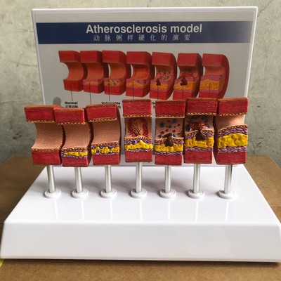 动脉粥样硬化模型血管血栓栓塞模型动脉血管人体医用医学教学模型