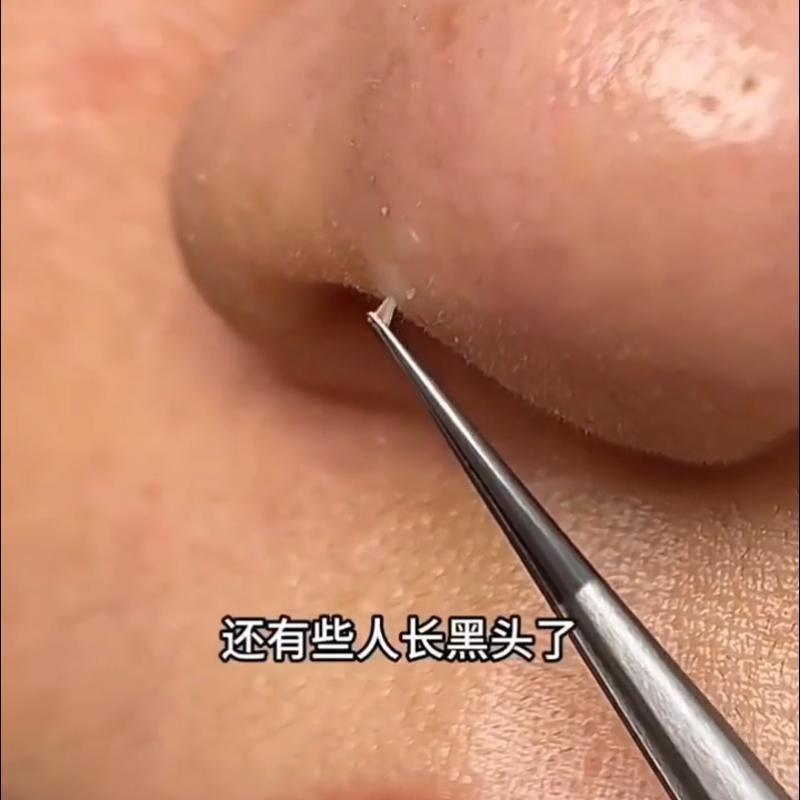 细胞夹黑头超细美容院专用高精密医用型粉刺针专业镊子弯头套装