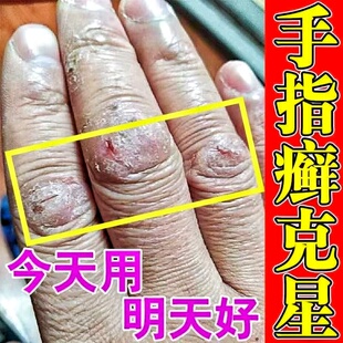 手指裂口子指甲缝勒口疼脱皮干裂膏秋冬季手指开裂干燥粗糙修复霜