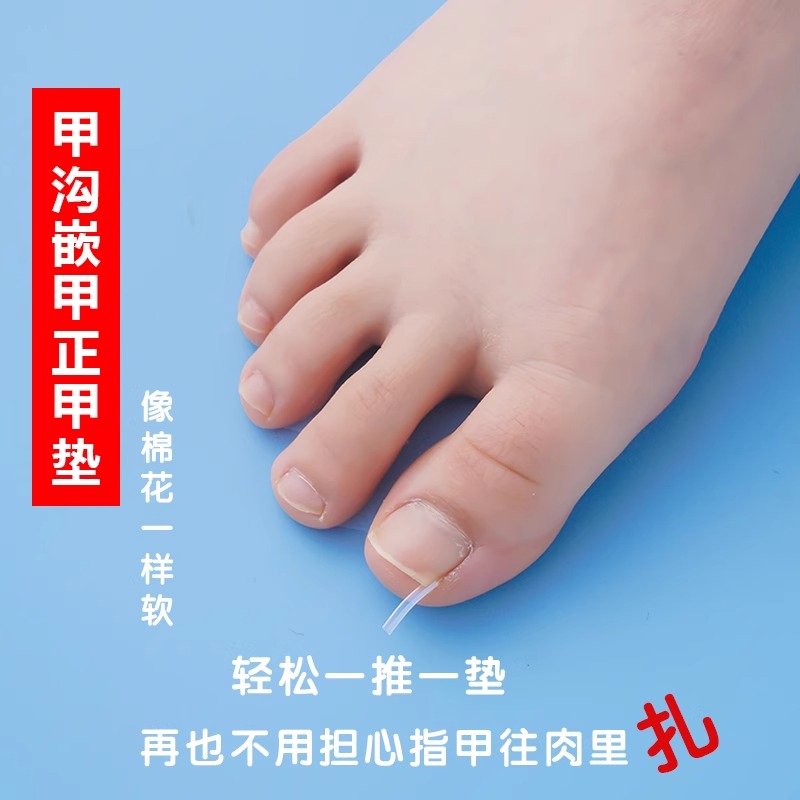 甲溝炎矯正器糾正隔離填充墊片