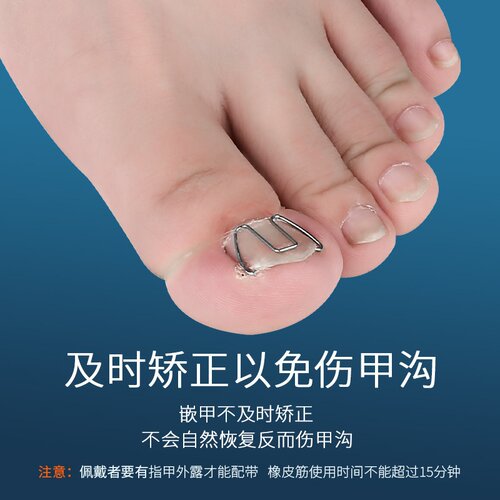 正甲勾指甲往肉里长甲沟纠正勾炎嵌甲矫正丝脚趾甲矫正器修脚工具