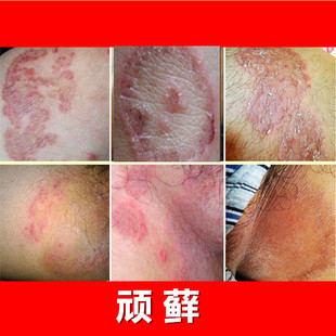 【3号霜】汗斑、头皮 癣、体藓、股藓、脚藓、脚气、花斑藓