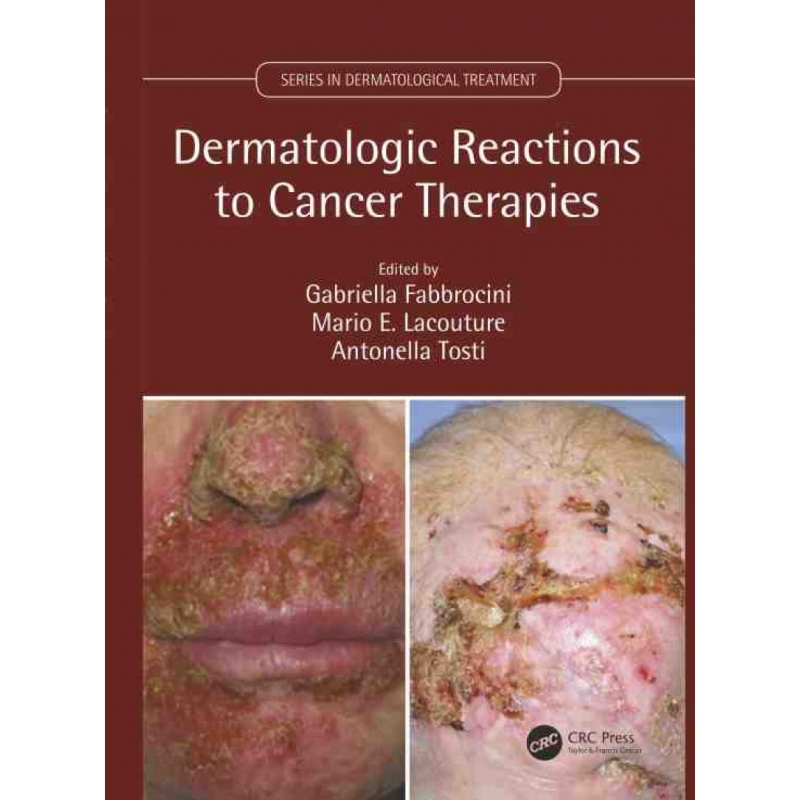 TF Dermatologic Reactions to Cancer Therapies 博库网