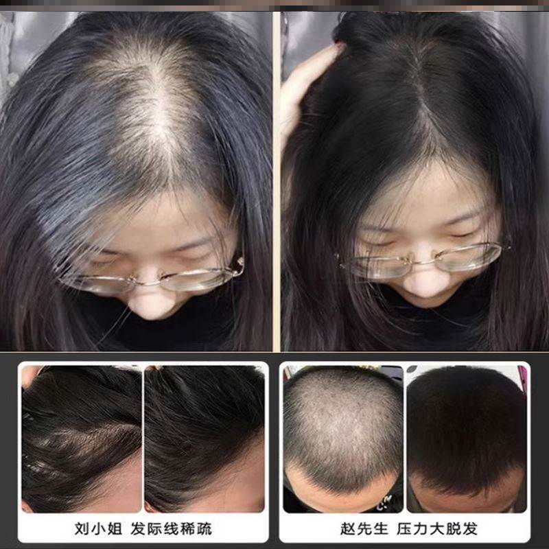 掉发防脱生发胶囊白云山生姜育发液发控油蓬松惠精华乌发水姜
