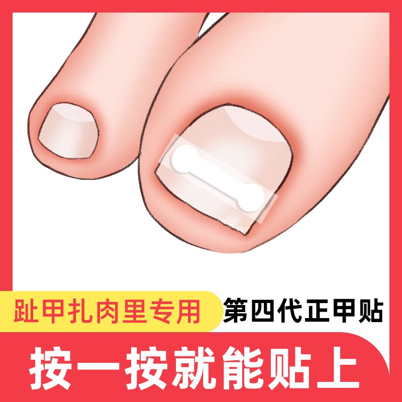 专用垫片拉拉里扎正甲贴