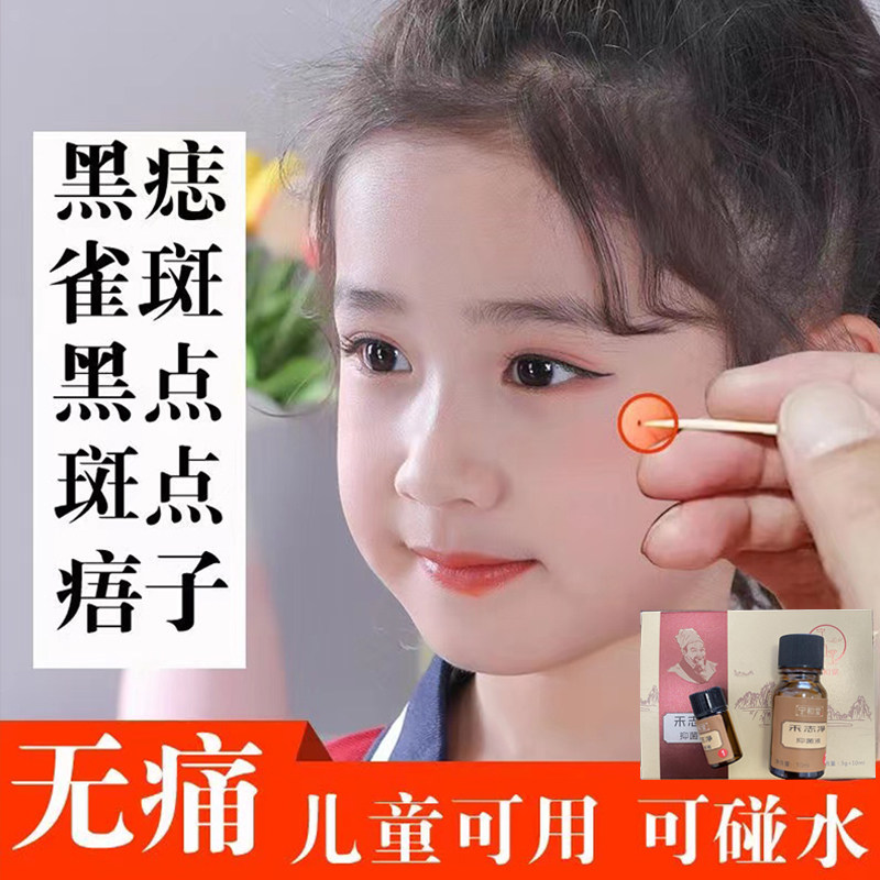 去痣祛痣点痣膏无痕药水正品脸部点痦子取痣除痣去黑痣不留疤专用