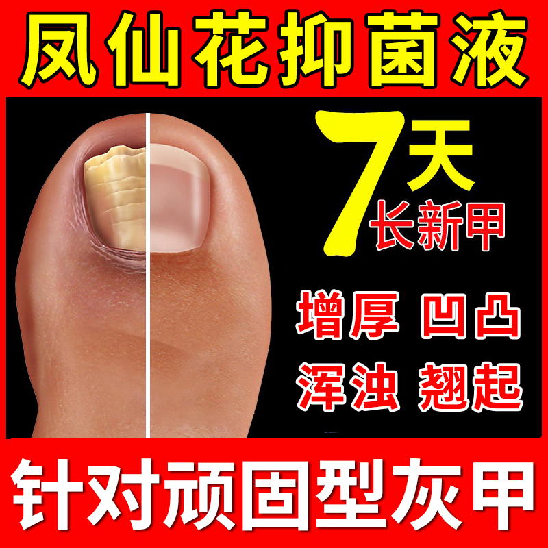南京同仁堂凤仙花灰指甲抑菌液瑞店官方正品旗舰灰趾甲修复护理液