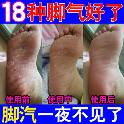 儿童脚气痒臭烂脚丫止专用脱皮糜烂脚趾出汗杀菌真菌感染喷雾非膏