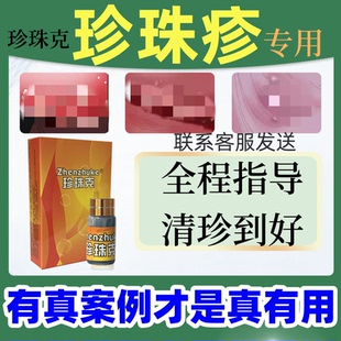 珍珠克冠状沟珍珠粒疹丘疹去除珍珠疹克星龟专用头男士