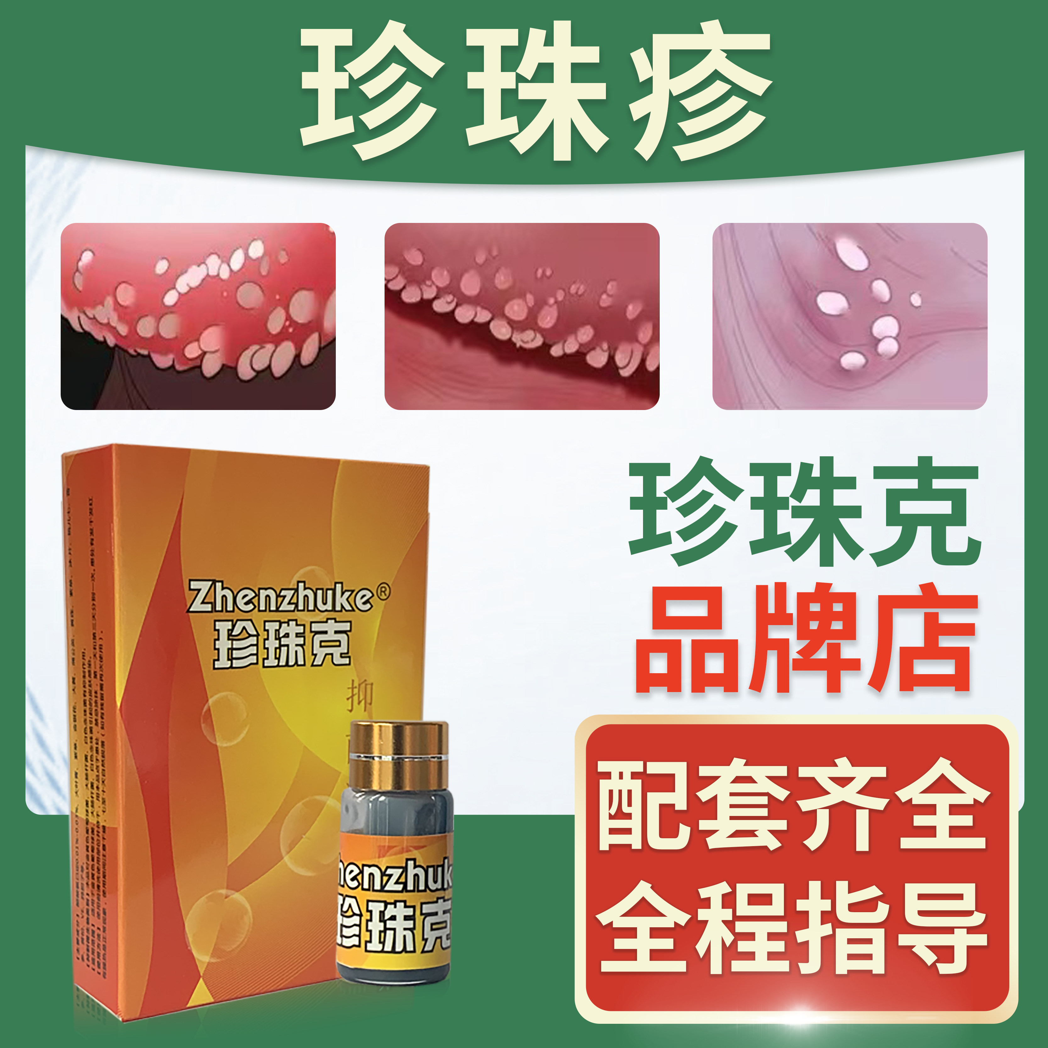 珍珠克冠状沟珍珠粒疹