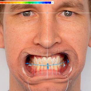 门牙假牙套牙仿真牙齿贴面全瓷牙贴片遮盖缺牙神器临时遮丑牙套