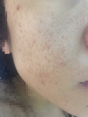 易科美纳米点阵靠谱吗，姐妹们效果经得起验证吗？