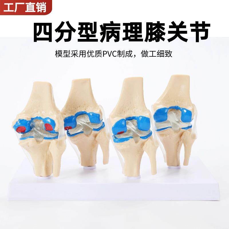 四分型膝关节正常与膝盖骨病变组合模型人骨架模型人体模型