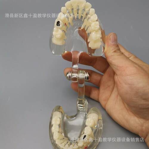 混合牙列模型 展示儿童换牙 乳恒牙交替带蛀牙展示 水晶透明模具