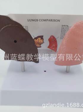 人体内脏健康肺与病态肺比较模型正常肺解剖模型病理肺对比模型