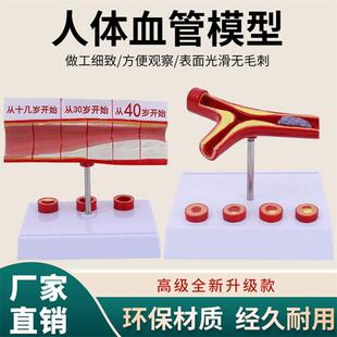 血管/堵塞动支脉粥样/硬化心血管动脉/硬化模型血管病理模型血栓