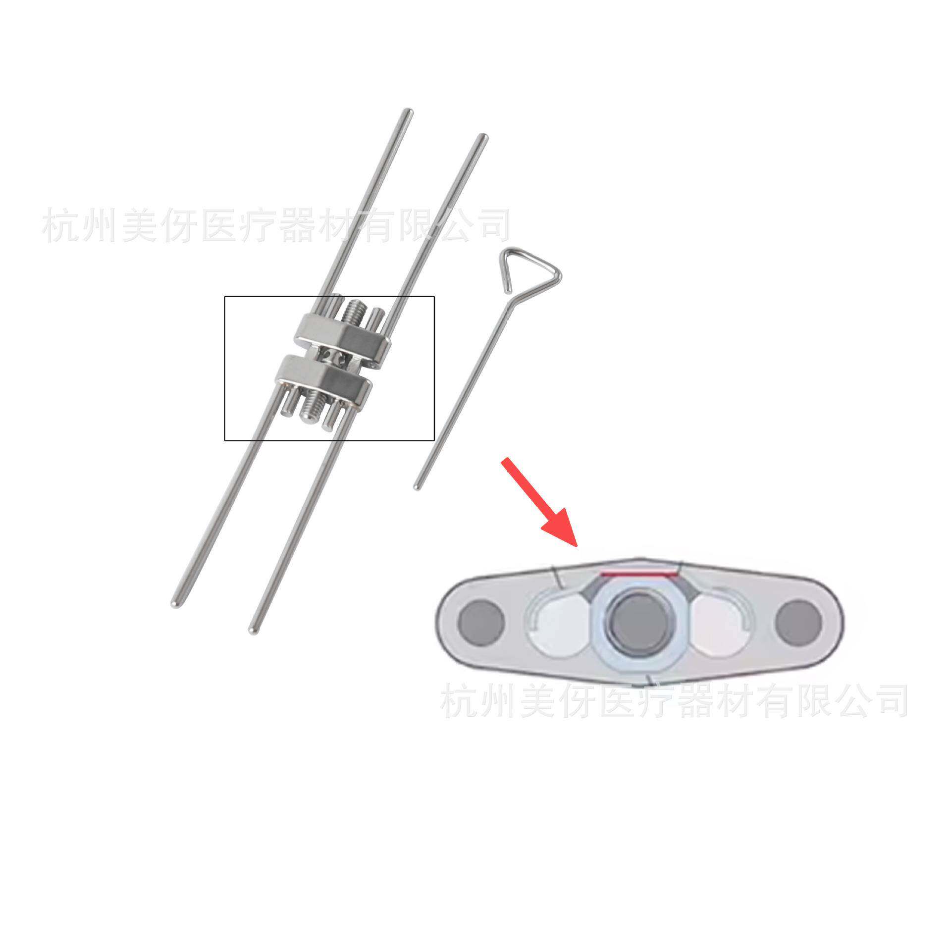正畸治疗高效固定式扩弓器专为改善咬合设计#8#9#11#13