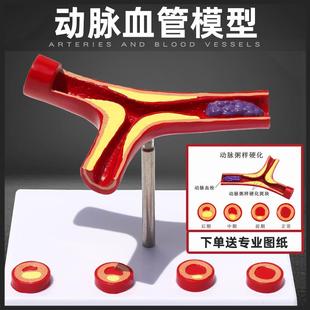 血管堵塞动支脉粥样硬化心血管模型病理动态血管血栓流动对比模型
