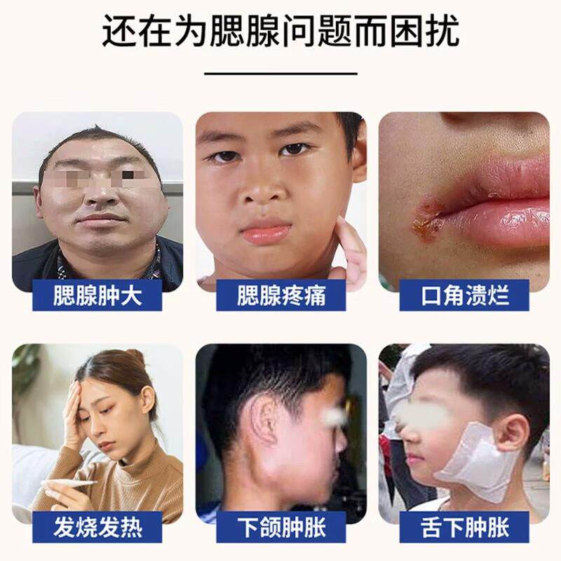 腮腺炎膏药贴消肿仙人掌淋巴结肿大散结贴膏淋巴结炎腮腺体变小EM