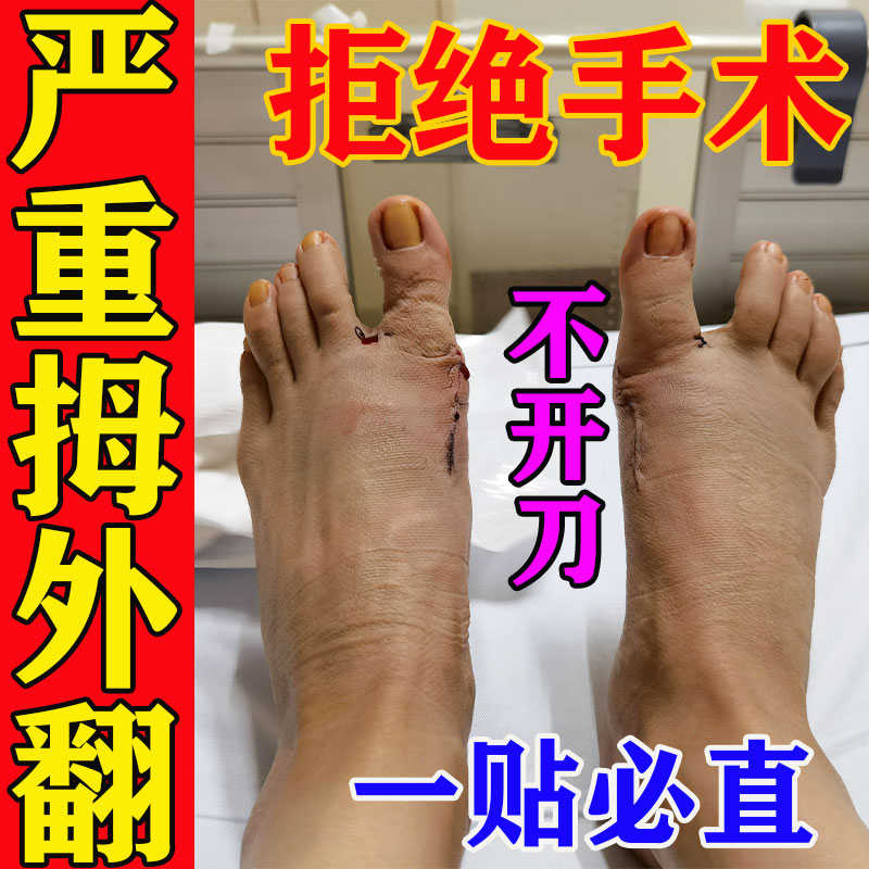 拇指外翻中药贴升级版【快速止痛】大脚骨畸形矫正贴防磨脚足神器