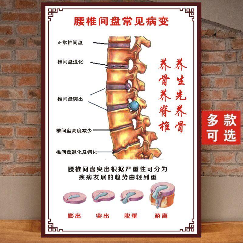 人体颈椎脊椎医学骨骼挂图椎间盘常见病变腰椎间盘突挂图海报制作