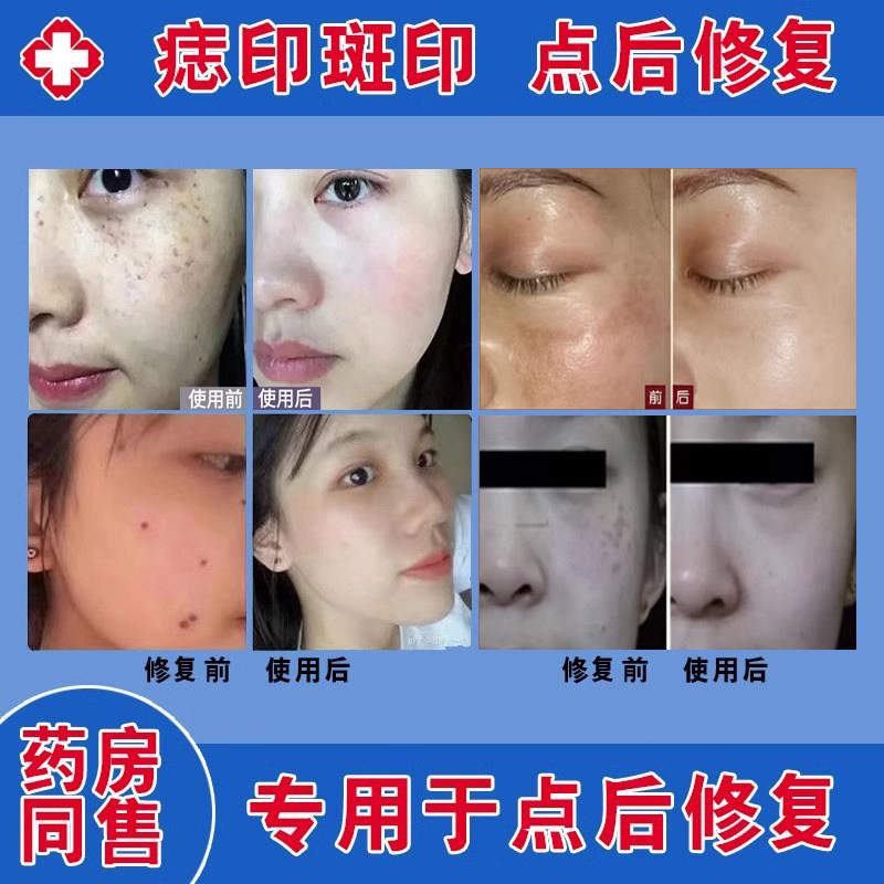 点斑点痣后专用修复液去红印修复凹坑激光斑皮秒术后修复膏冰晶祛