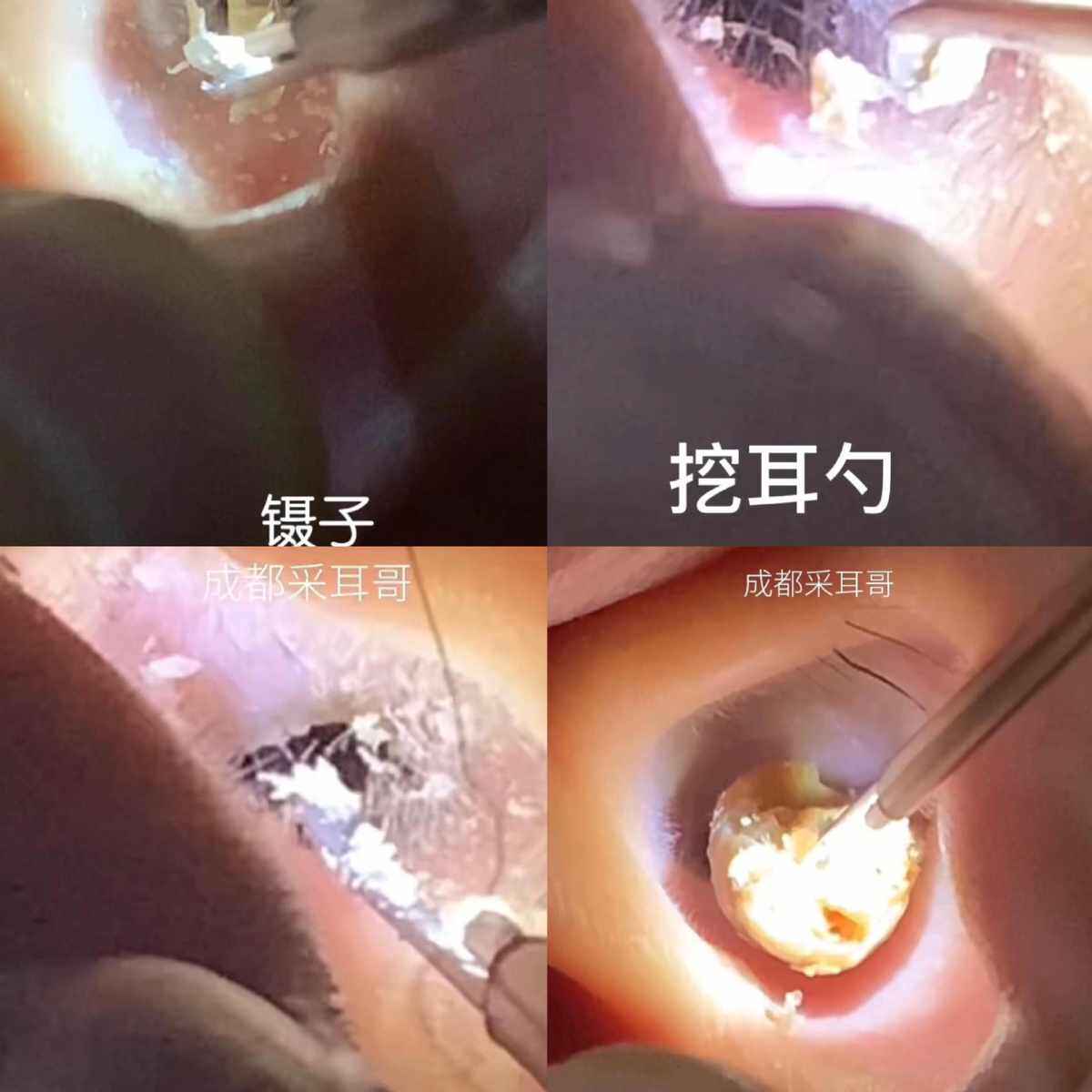发光采耳工具掏耳朵吸耳屎挖耳朵专业采耳工具成人儿童清洁器套装