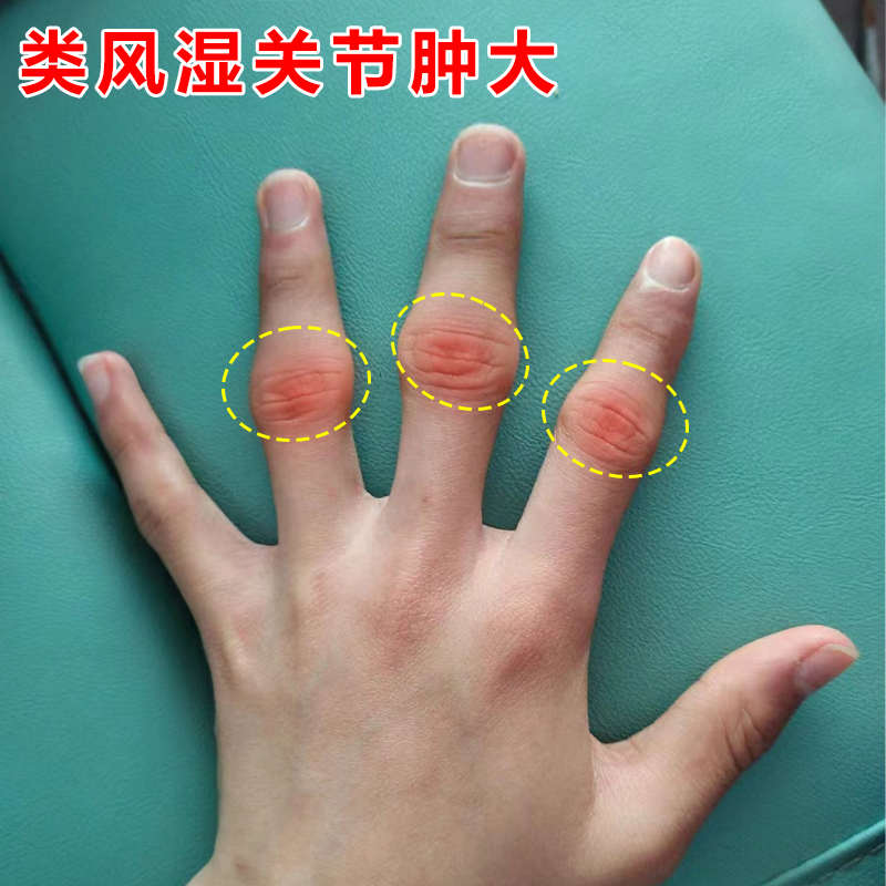 【当晚】内手指关节变形肿大湿粗疼痛酸麻胀僵硬透骨膏